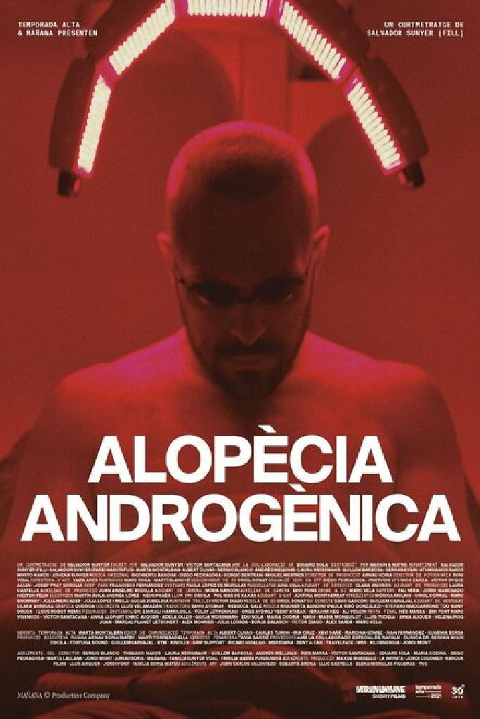 Alopècia androgènica