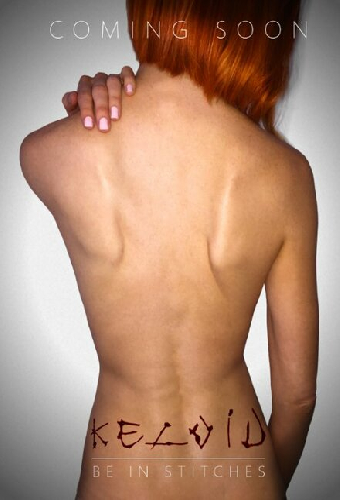 Keloid