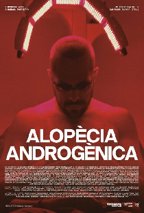 Alopècia androgènica
